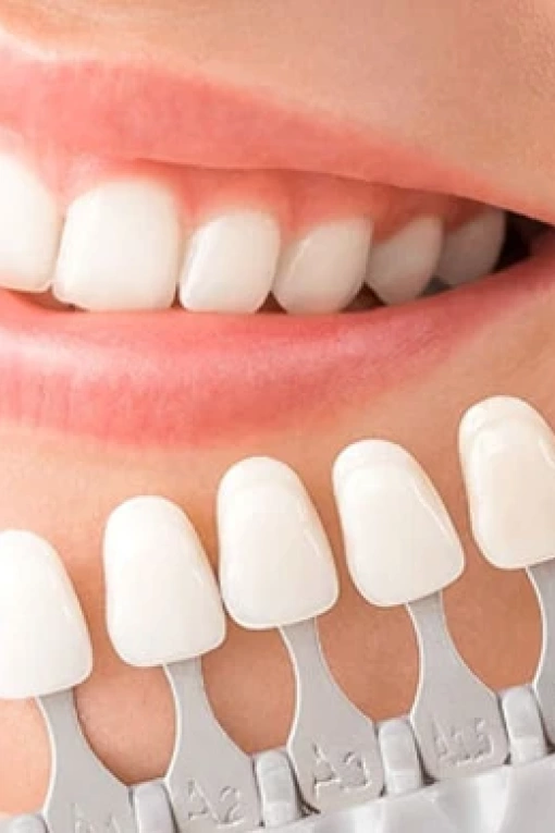 Facetas em resina composta