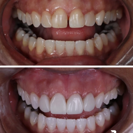 Nem toda transformação começa com um grande problema.  Às vezes, um pequeno espaço entre os dentes, uma alteração na cor ou detalhes que parecem discretos já são suficientes para fazer alguém perder a confiança ao sorrir.  Neste caso, o objetivo nunca foi criar um sorriso diferente.  Foi preservar a identidade do paciente, corrigindo pequenas imperfeições e devolvendo mais harmonia e naturalidade.  📱 (31) 98207-2813 📍 Ponte Nova – MG  #odonto #odontologiaestetica #dentista #pontenova #sorriso