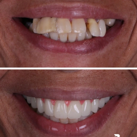 Algumas transformações impressionam pelo resultado.  Outras impressionam pela história que carregam.  Este sorriso não mudou apenas de aparência. Ele passou a transmitir mais confiança, mais harmonia e uma versão do paciente que já existia, mas estava escondida por trás de anos de insegurança.  Cada detalhe foi cuidadosamente planejado para que o resultado fosse funcional e duradouro.  📱 (31) 98207-2813 📍 Ponte Nova – MG  #odonto #odontologiaestetica #dentista #pontenova #sorriso