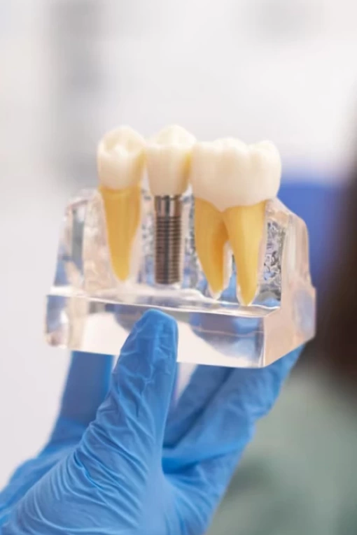 Implantes dentários
