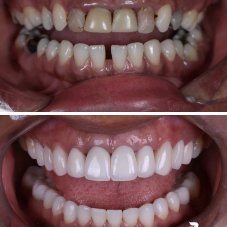 Tem casos em que o antes e depois praticamente dispensam explicações.  Mas, por trás de uma transformação como essa, existe muito mais do que uma mudança na aparência dos dentes. Existe planejamento, reconstrução, atenção à função e, principalmente, uma visão de conjunto: entender o que aquele sorriso precisava para voltar a ter equilíbrio.  O resultado é uma mudança expressiva, mas construída para fazer sentido para o paciente!  ✨ Studio Oral 📱 (31) 98207-2813 📍 Ponte Nova – MG  #odonto #odontologia #saudebucal #dentista #pontenovamg