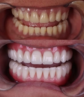 Implantes dentários