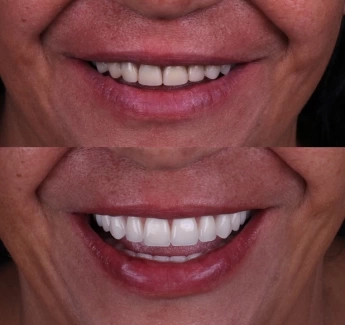 Implantes dentários