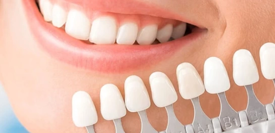 Facetas em resina composta