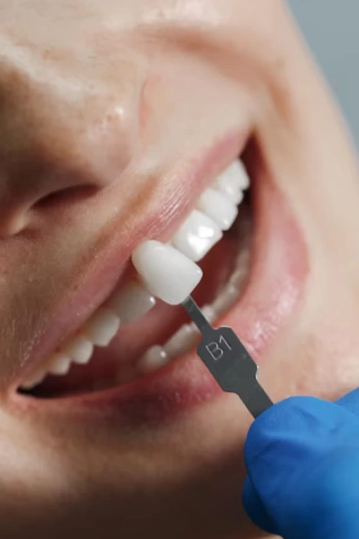 Implantes dentários