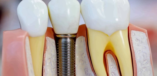 Implantes dentários