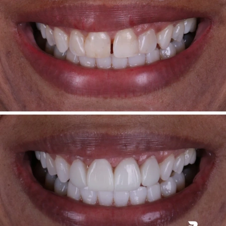 No caso dessa paciente, um pequeno espaço entre os dentes anteriores e outras pequenas imperfeições deram lugar a um sorriso mais harmônico, mantendo aquilo que mais valorizamos na odontologia estética: a naturalidade.  O objetivo nunca é criar um sorriso igual para todos.  É planejar um resultado que respeite as características de cada paciente e faça sentido para o seu rosto, sua expressão e sua personalidade.  📱 (31) 98207-2813 📍 Ponte Nova – MG  #odonto #odontologiaestetica #dentista #pontenova #sorriso