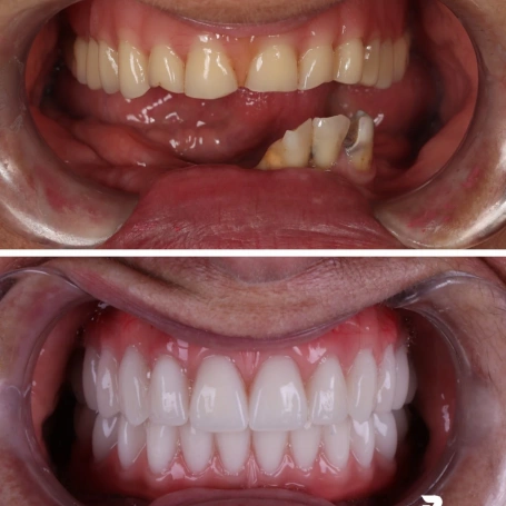 O sorriso mudou completamente. A rotina também.  Quando existe perda de dentes, não é apenas a aparência que muda.  A pessoa pode começar a evitar determinados alimentos, esconder o sorriso, falar com mais cautela e até deixar de aparecer em fotografias.  Por isso, um caso como este não pode ser visto apenas como um antes e depois.  É uma reconstrução que devolve função, segurança e liberdade para sorrir.  E talvez essa seja a parte mais importante de qualquer transformação odontológica: aquilo que o paciente volta a fazer sem pensar duas vezes.  ✨ Studio Oral 📱 (31) 98207-2813 📍 Ponte Nova – MG